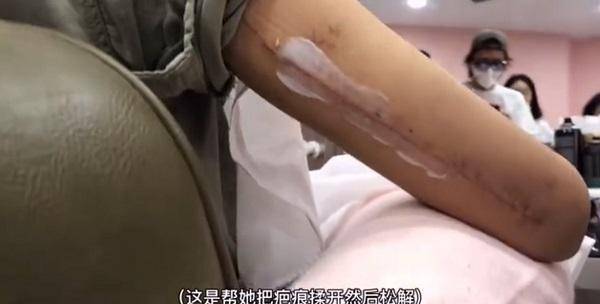 开云APP：工作室曝万茜复健视频回应“假骨折”打钢板留20cm疤痕看着都疼(图4)